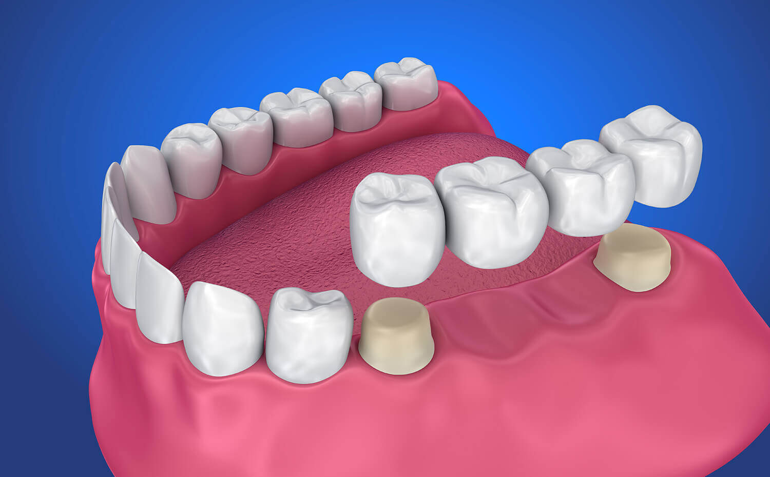 Fixed Restorative